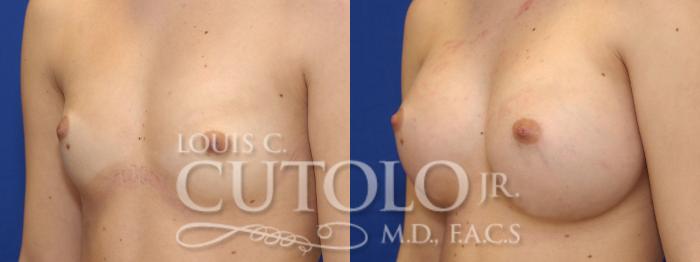 Before & After Breast Augmentation Case 7 View #2 View in Brooklyn, Staten Island, Queens, NY