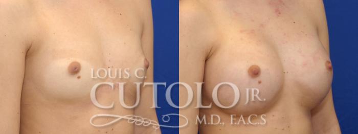 Before & After Breast Augmentation Case 7 View #3 View in Brooklyn, Staten Island, Queens, NY