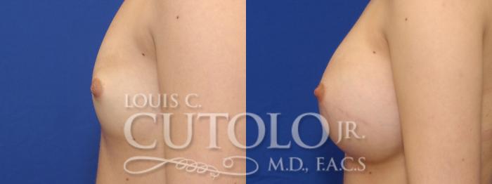 Before & After Breast Augmentation Case 7 View #4 View in Brooklyn, Staten Island, Queens, NY