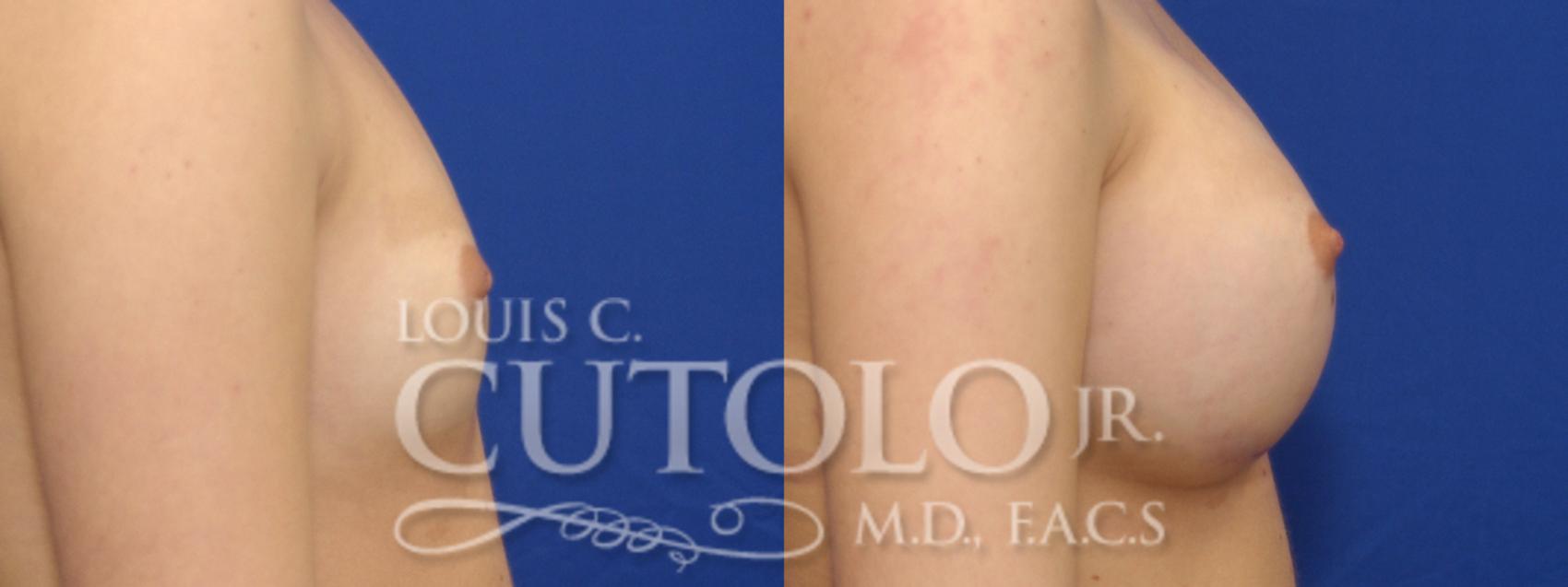 Before & After Breast Augmentation Case 7 View #5 View in Brooklyn, Staten Island, Queens, NY