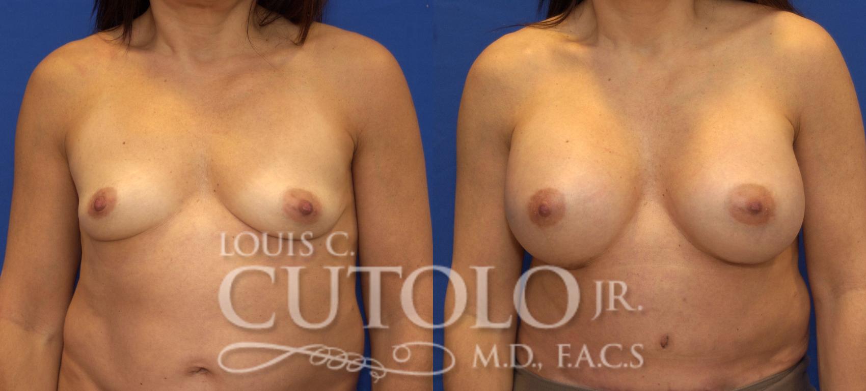 Before & After Breast Augmentation Case 70 View #1 View in Brooklyn, Staten Island, Queens, NY