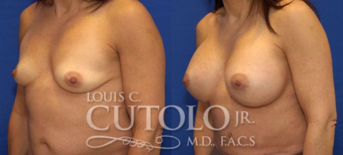 Before & After Breast Augmentation Case 70 View #2 View in Brooklyn, Staten Island, Queens, NY