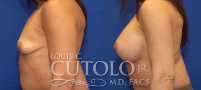 Before & After Breast Augmentation Case 70 View #3 View in Brooklyn, Staten Island, Queens, NY