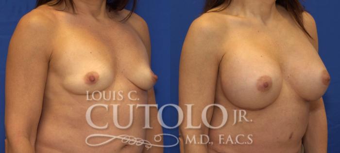 Before & After Breast Augmentation Case 70 View #4 View in Brooklyn, Staten Island, Queens, NY