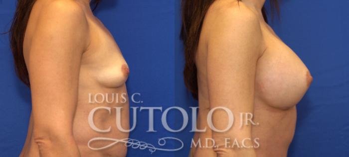 Before & After Breast Augmentation Case 70 View #5 View in Brooklyn, Staten Island, Queens, NY