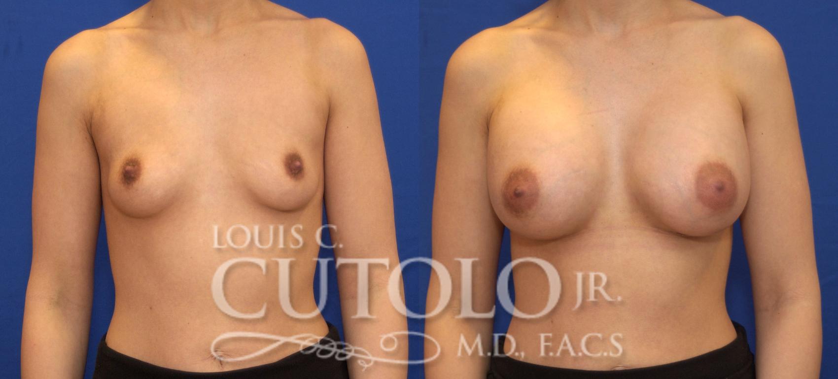 Before & After Breast Augmentation Case 71 View #1 View in Brooklyn, Staten Island, Queens, NY