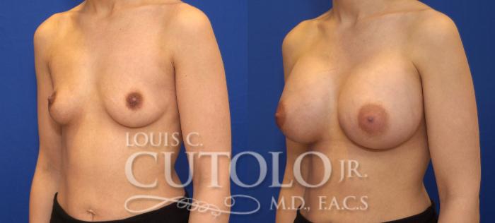 Before & After Breast Augmentation Case 71 View #2 View in Brooklyn, Staten Island, Queens, NY