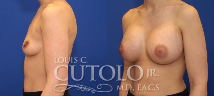 Before & After Breast Augmentation Case 71 View #3 View in Brooklyn, Staten Island, Queens, NY