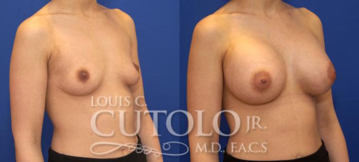 Before & After Breast Augmentation Case 71 View #4 View in Brooklyn, Staten Island, Queens, NY