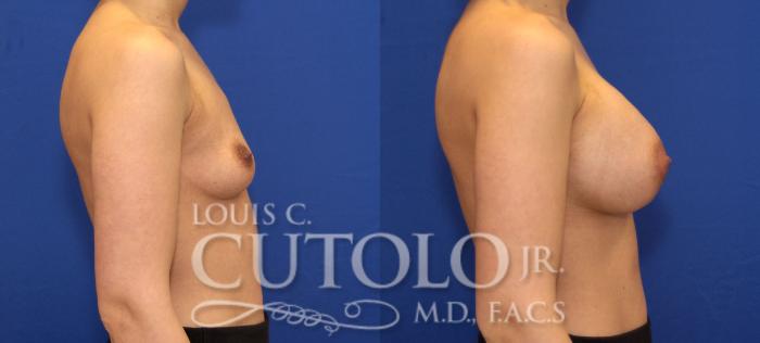 Before & After Breast Augmentation Case 71 View #5 View in Brooklyn, Staten Island, Queens, NY