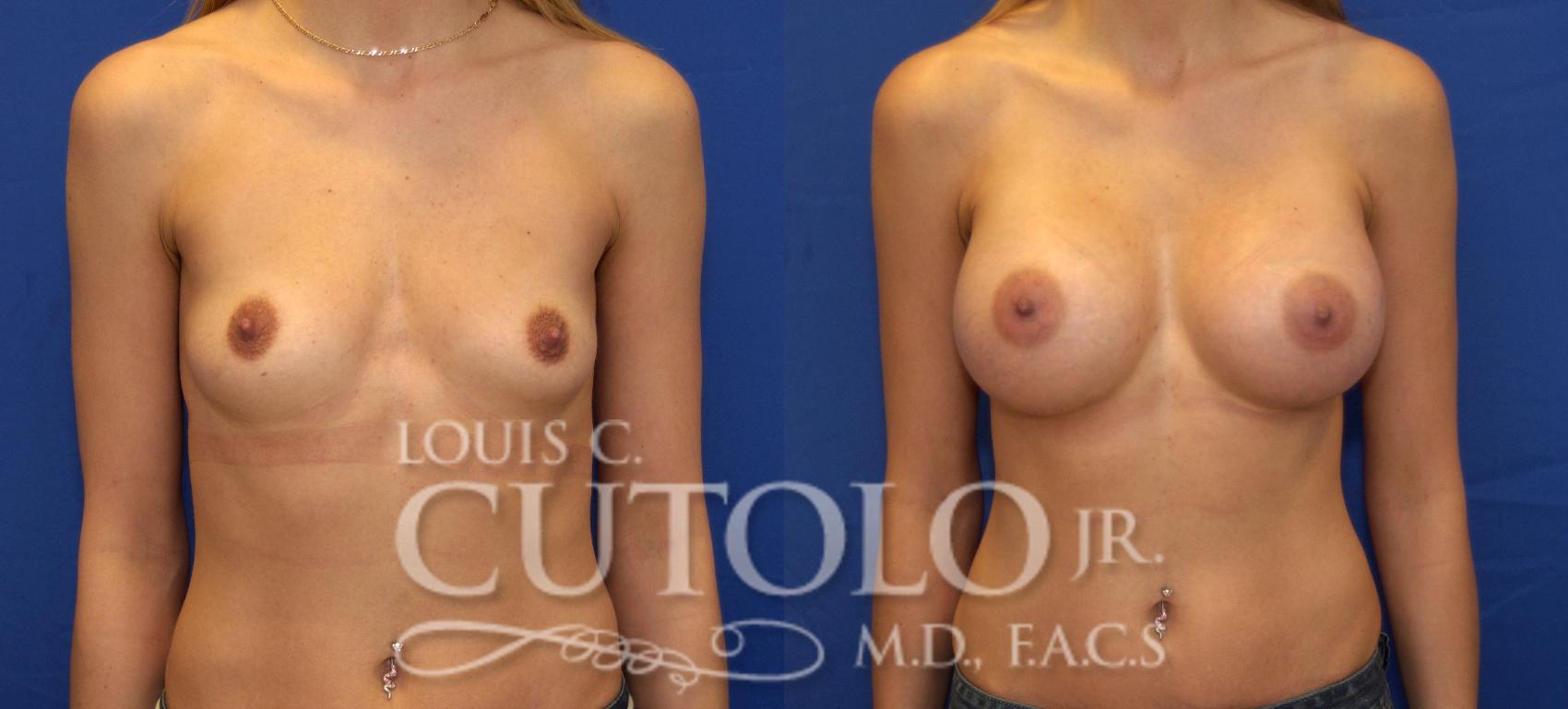 Before & After Breast Augmentation Case 74 View #1 View in Brooklyn, Staten Island, Queens, NY