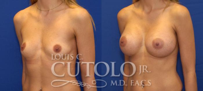 Before & After Breast Augmentation Case 74 View #2 View in Brooklyn, Staten Island, Queens, NY