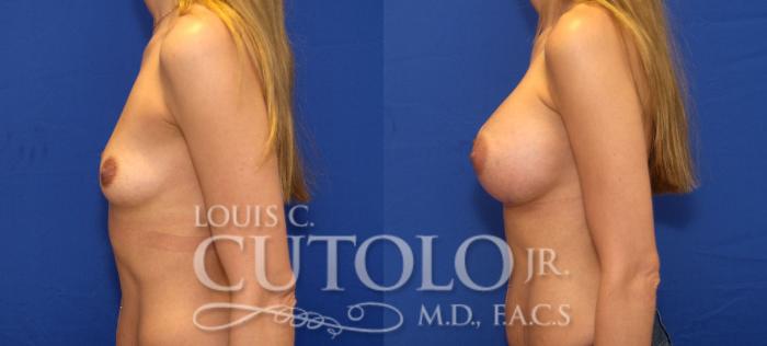 Before & After Breast Augmentation Case 74 View #3 View in Brooklyn, Staten Island, Queens, NY