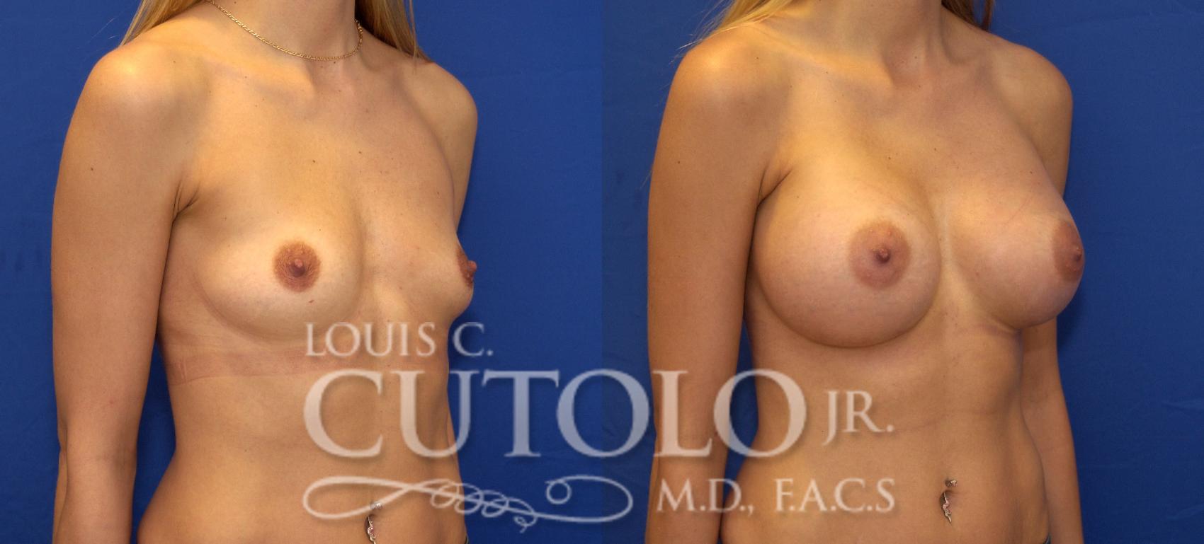 Before & After Breast Augmentation Case 74 View #4 View in Brooklyn, Staten Island, Queens, NY