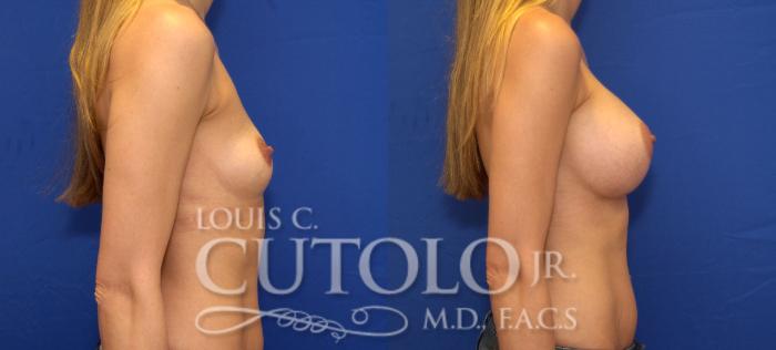 Before & After Breast Augmentation Case 74 View #5 View in Brooklyn, Staten Island, Queens, NY