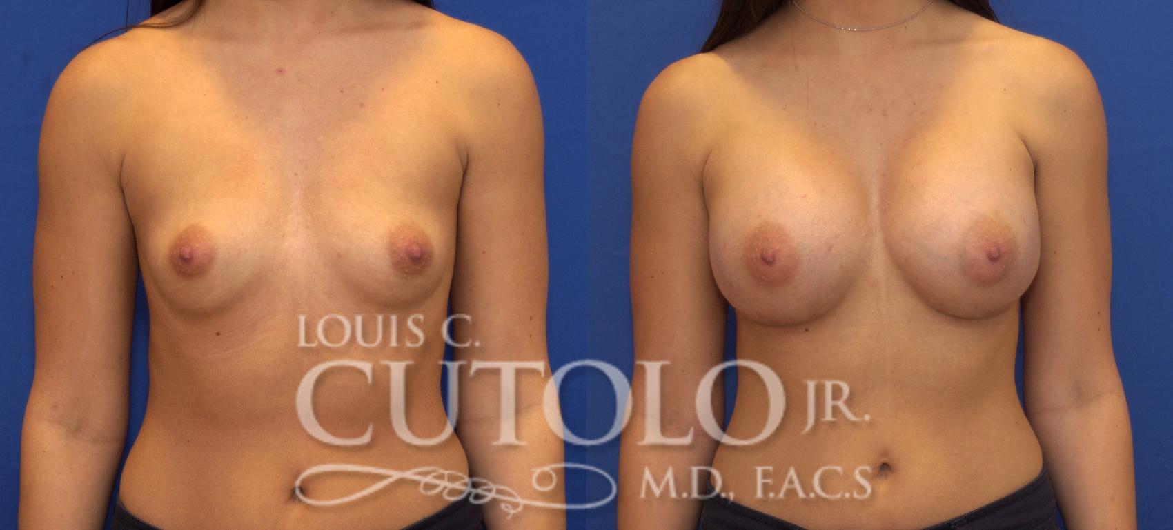 Before & After Breast Augmentation Case 75 View #1 View in Brooklyn, Staten Island, Queens, NY