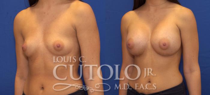 Before & After Breast Augmentation Case 75 View #2 View in Brooklyn, Staten Island, Queens, NY