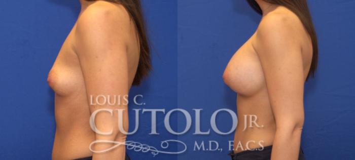 Before & After Breast Augmentation Case 75 View #3 View in Brooklyn, Staten Island, Queens, NY