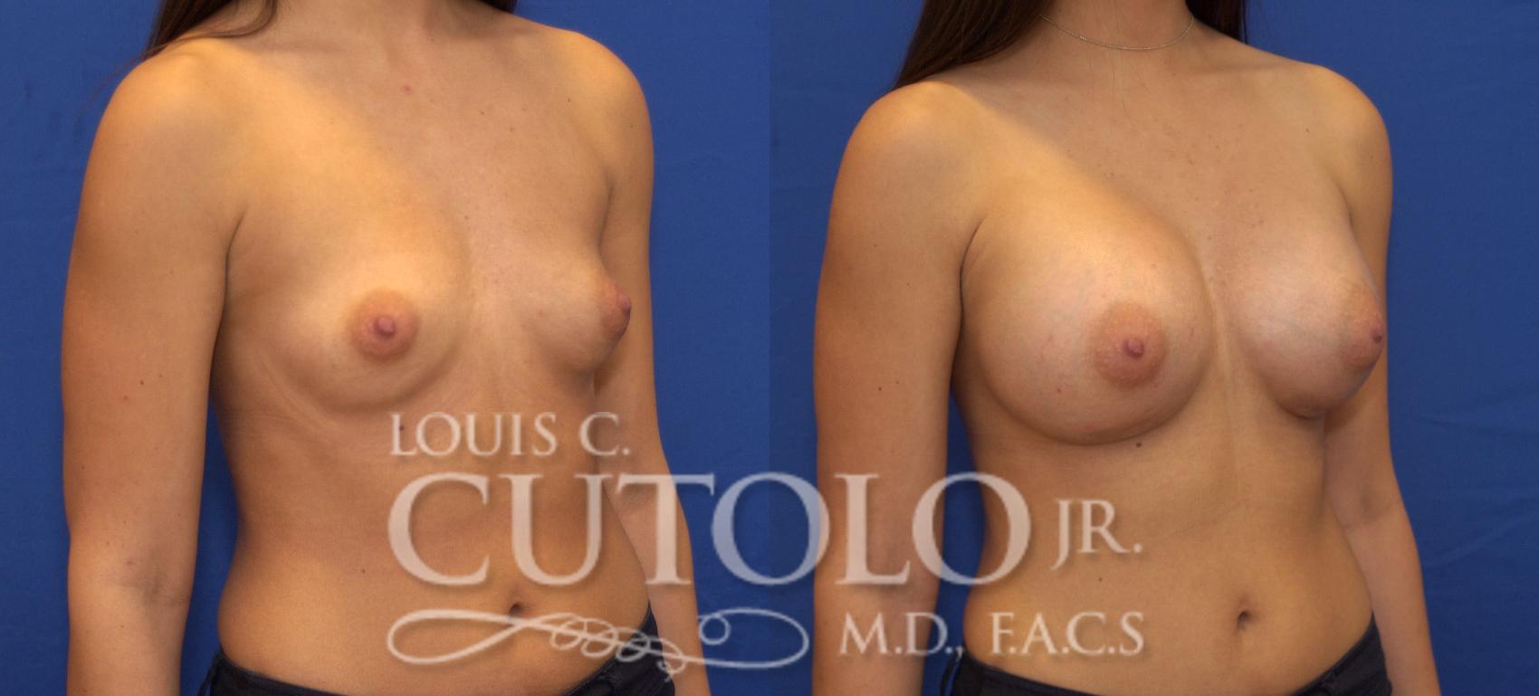 Before & After Breast Augmentation Case 75 View #4 View in Brooklyn, Staten Island, Queens, NY
