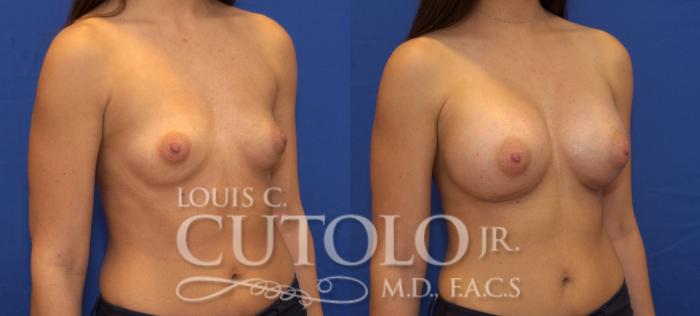 Before & After Breast Augmentation Case 75 View #4 View in Brooklyn, Staten Island, Queens, NY