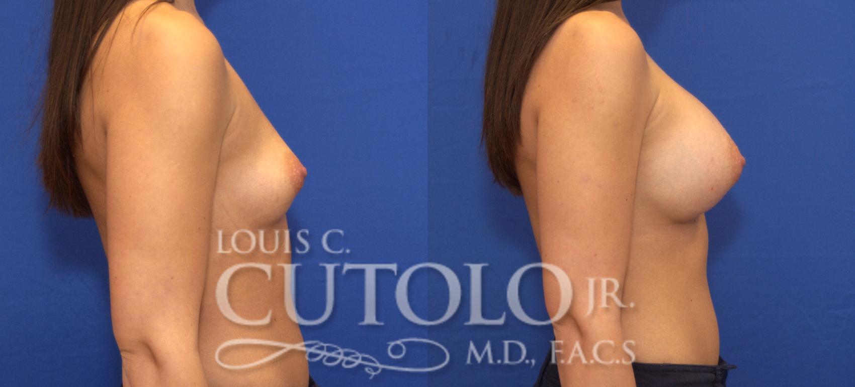Before & After Breast Augmentation Case 75 View #5 View in Brooklyn, Staten Island, Queens, NY