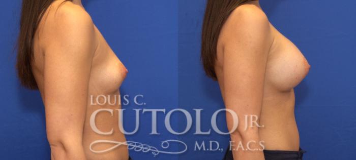 Before & After Breast Augmentation Case 75 View #5 View in Brooklyn, Staten Island, Queens, NY