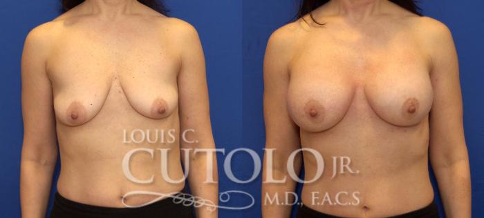 Before & After Breast Augmentation Case 77 View #1 View in Brooklyn, Staten Island, Queens, NY