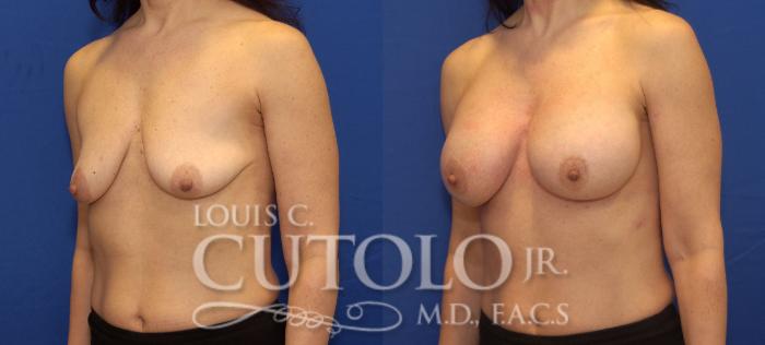 Before & After Breast Augmentation Case 77 View #2 View in Brooklyn, Staten Island, Queens, NY