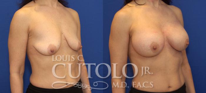 Before & After Breast Augmentation Case 77 View #4 View in Brooklyn, Staten Island, Queens, NY