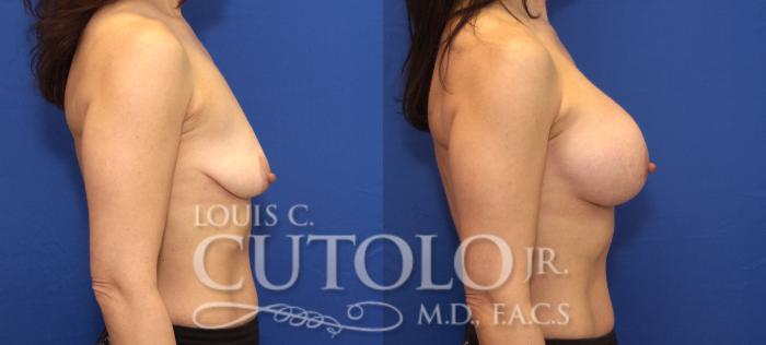 Before & After Breast Augmentation Case 77 View #5 View in Brooklyn, Staten Island, Queens, NY
