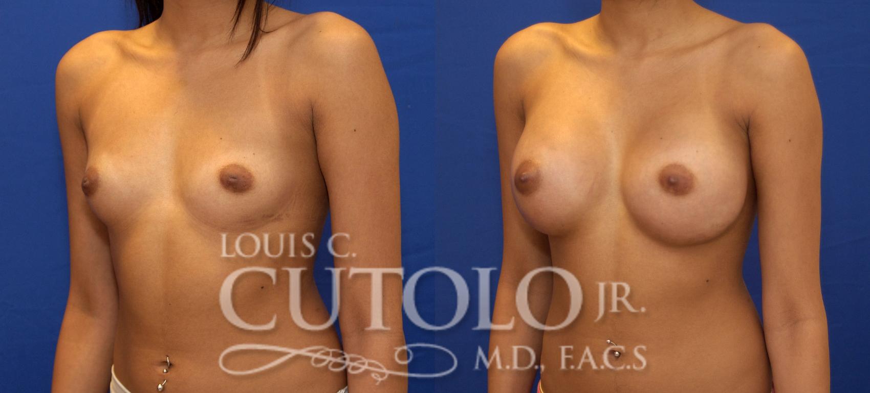 Before & After Breast Augmentation Case 78 View #2 View in Brooklyn, Staten Island, Queens, NY