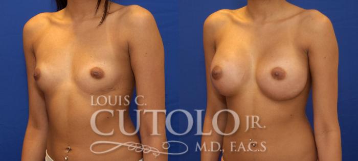 Before & After Breast Augmentation Case 78 View #2 View in Brooklyn, Staten Island, Queens, NY