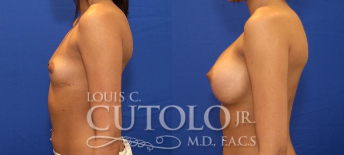 Before & After Breast Augmentation Case 78 View #3 View in Brooklyn, Staten Island, Queens, NY