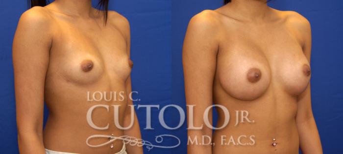 Before & After Breast Augmentation Case 78 View #4 View in Brooklyn, Staten Island, Queens, NY
