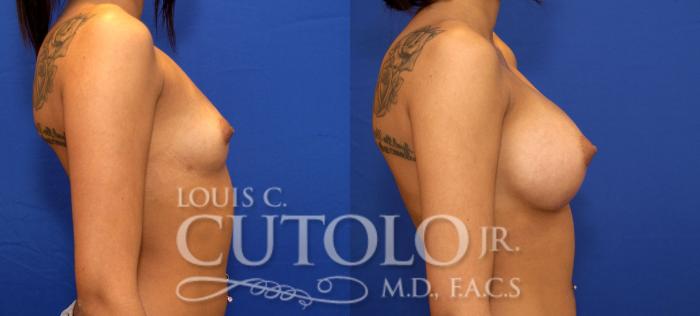 Before & After Breast Augmentation Case 78 View #5 View in Brooklyn, Staten Island, Queens, NY