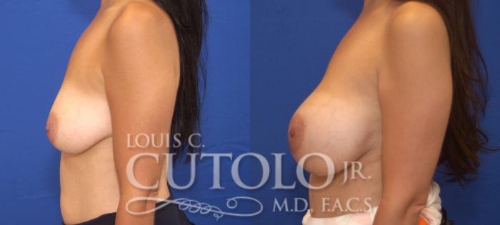 Before & After Breast Augmentation Case 79 View #3 View in Brooklyn, Staten Island, Queens, NY