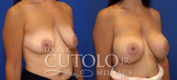 Before & After Breast Augmentation Case 79 View #4 View in Brooklyn, Staten Island, Queens, NY