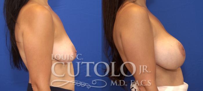 Before & After Breast Augmentation Case 79 View #5 View in Brooklyn, Staten Island, Queens, NY