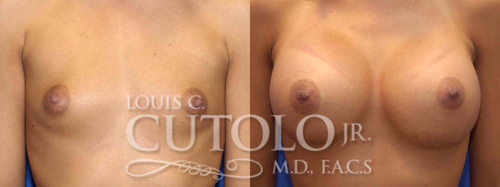 Before & After Breast Augmentation Case 8 View #1 View in Brooklyn, Staten Island, Queens, NY