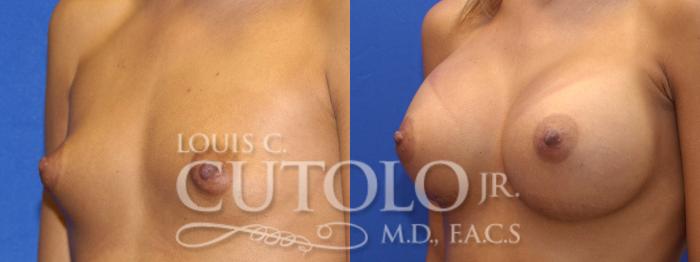 Before & After Breast Augmentation Case 8 View #2 View in Brooklyn, Staten Island, Queens, NY