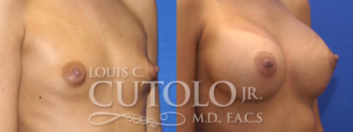 Before & After Breast Augmentation Case 8 View #3 View in Brooklyn, Staten Island, Queens, NY