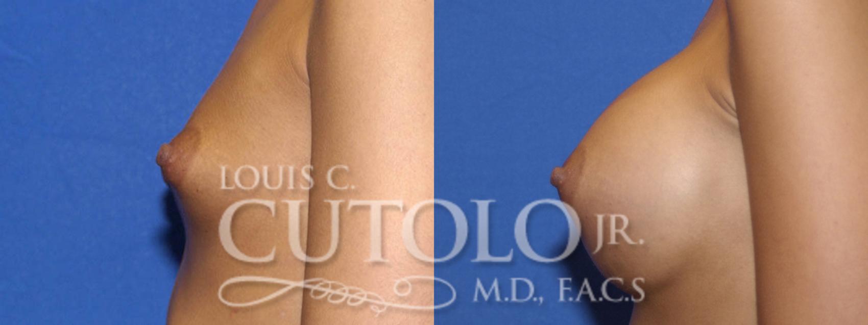 Before & After Breast Augmentation Case 8 View #4 View in Brooklyn, Staten Island, Queens, NY