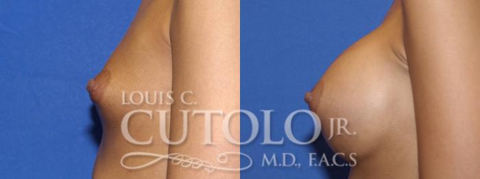 Before & After Breast Augmentation Case 8 View #4 View in Brooklyn, Staten Island, Queens, NY