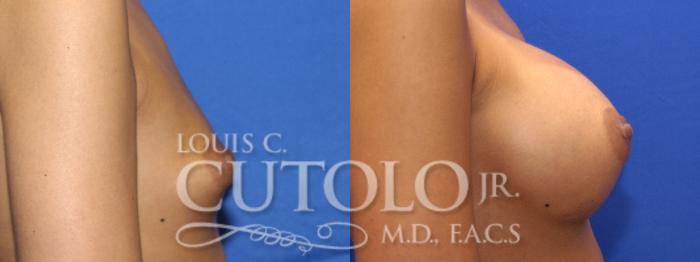Before & After Breast Augmentation Case 8 View #5 View in Brooklyn, Staten Island, Queens, NY