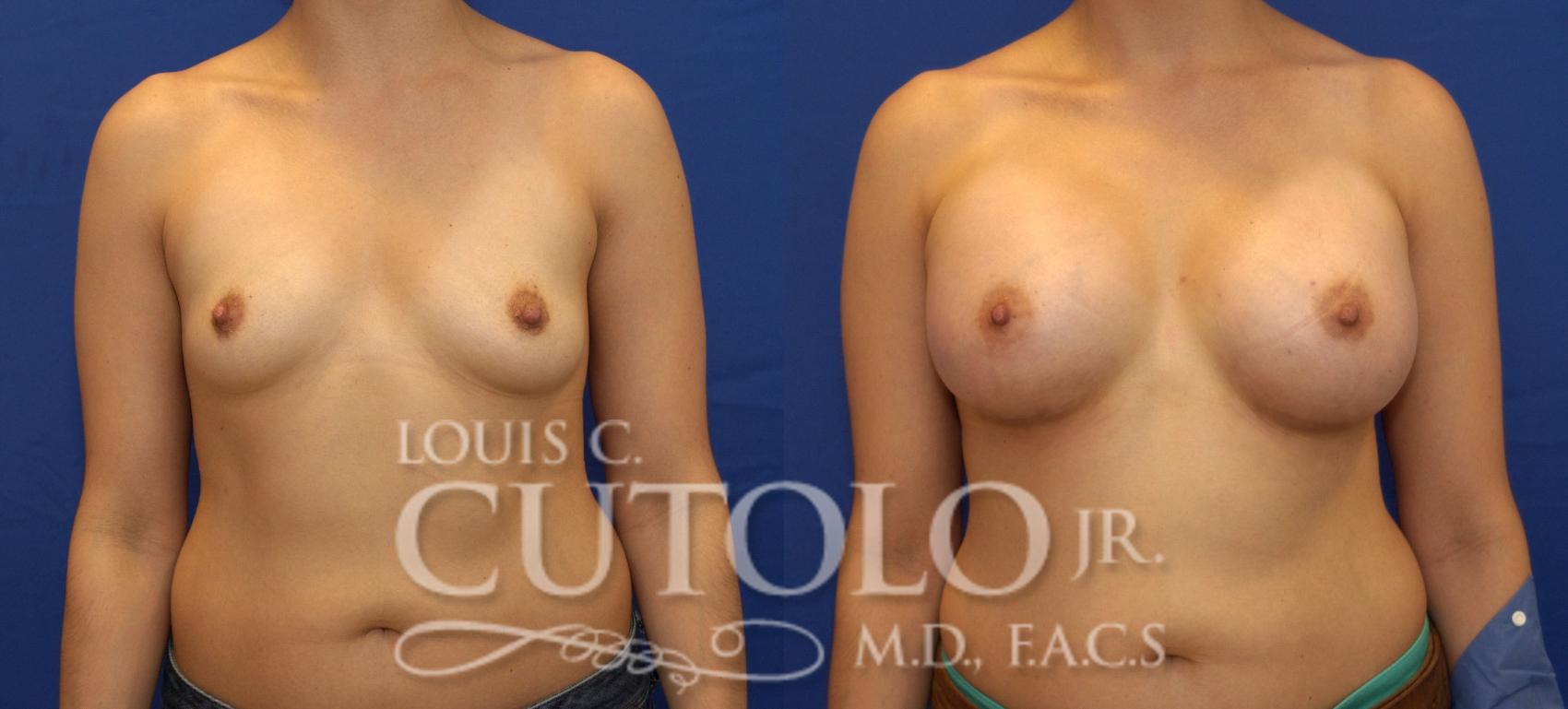 Before & After Breast Augmentation Case 83 View #1 View in Brooklyn, Staten Island, Queens, NY