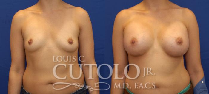 Before & After Breast Augmentation Case 83 View #1 View in Brooklyn, Staten Island, Queens, NY