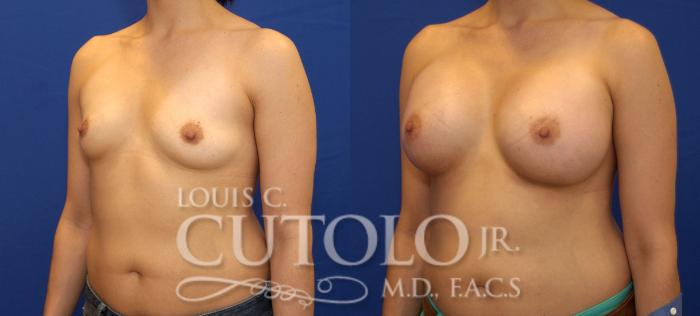 Before & After Breast Augmentation Case 83 View #2 View in Brooklyn, Staten Island, Queens, NY