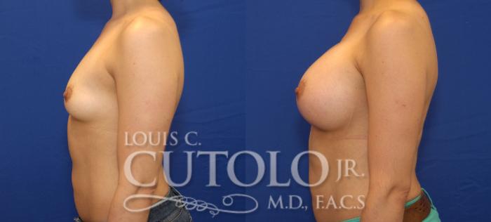 Before & After Breast Augmentation Case 83 View #3 View in Brooklyn, Staten Island, Queens, NY