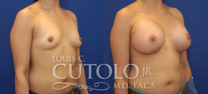 Before & After Breast Augmentation Case 83 View #4 View in Brooklyn, Staten Island, Queens, NY