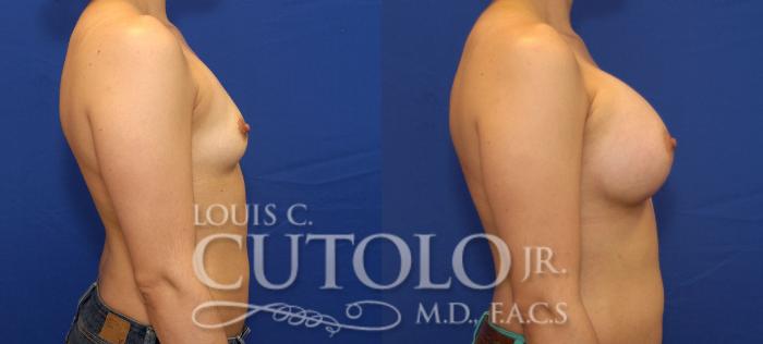 Before & After Breast Augmentation Case 83 View #5 View in Brooklyn, Staten Island, Queens, NY